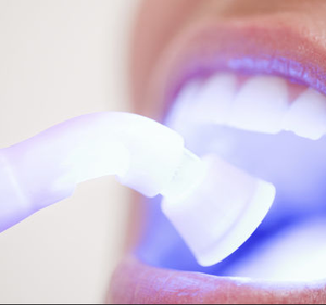 laser teeth whitening in hindi