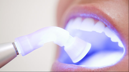 laser teeth whitening in hindi